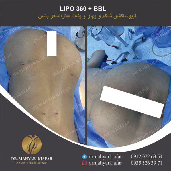لیپوابدومینوپلاستی