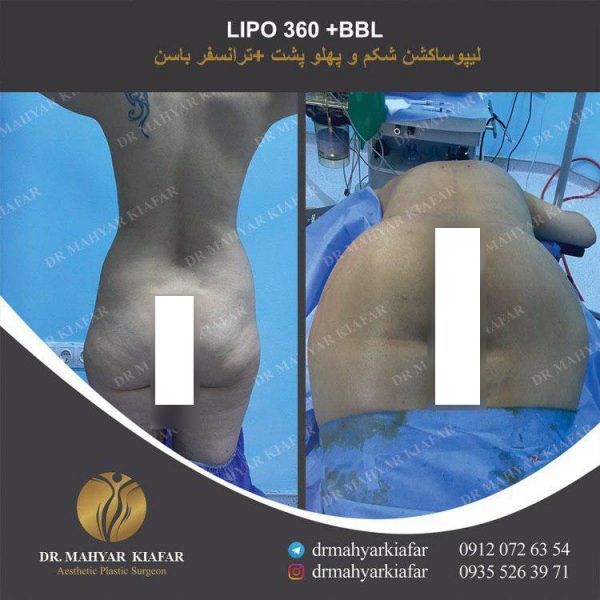 لیپوابدومینوپلاستی